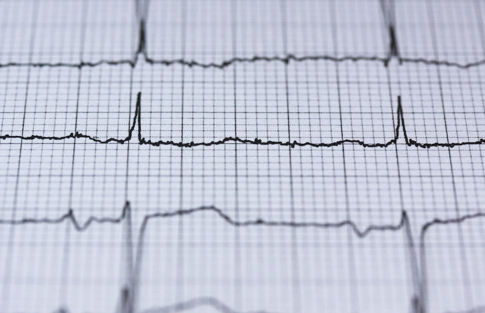 Electrocardiogram