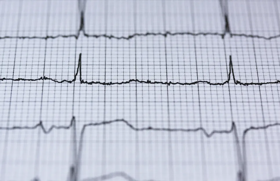 Electrocardiogram